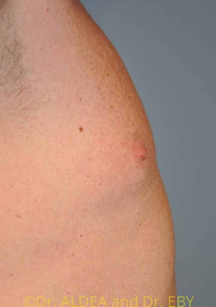 After Image: Nipple Reduction #063 - right-side