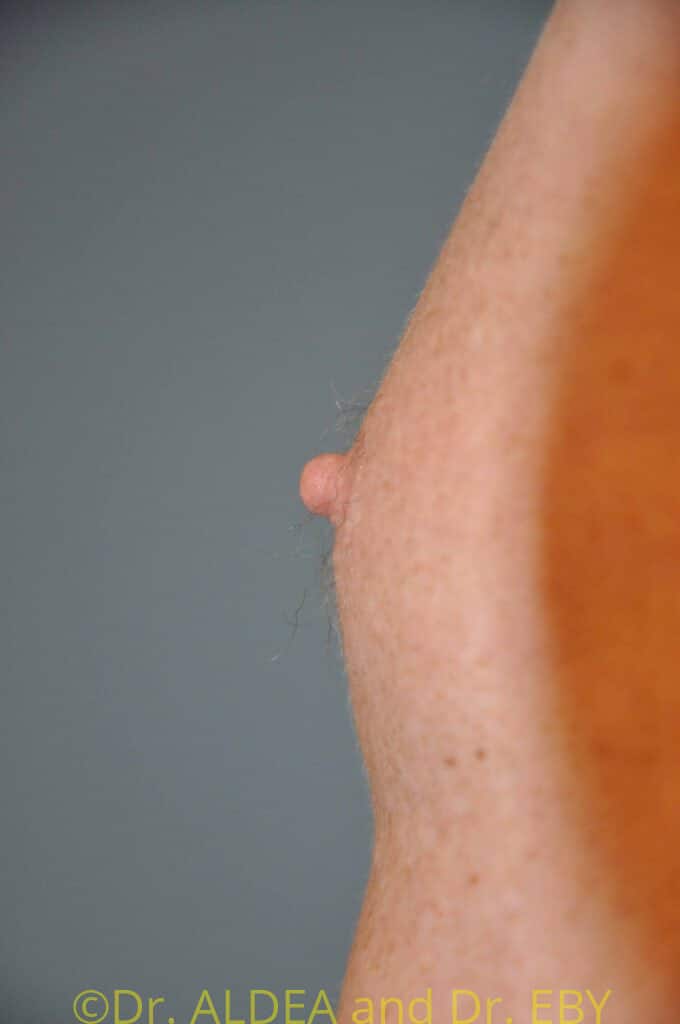 Before Image: Nipple Reduction #063 - left-side