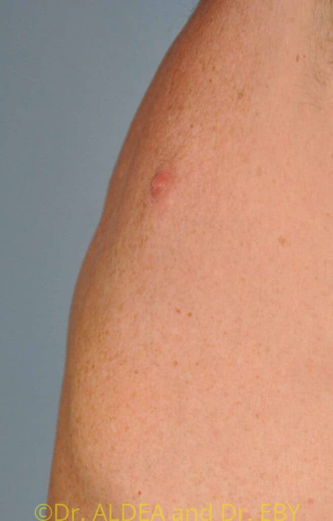 After Image: Nipple Reduction #063 - left-side