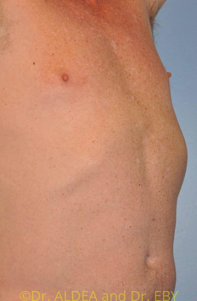 Before Image: Nipple Reduction #063 - right-front-oblique