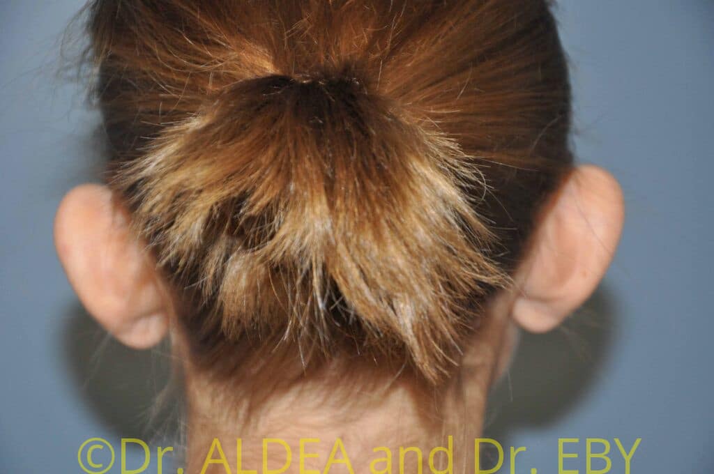 Before Image: Otoplasty (Prominent Ear Correction) #908 - back
