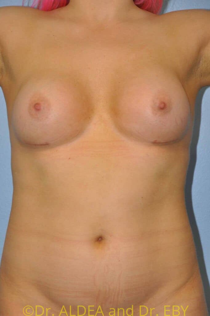 After Image: Trans Breast Augmentation #258 - front