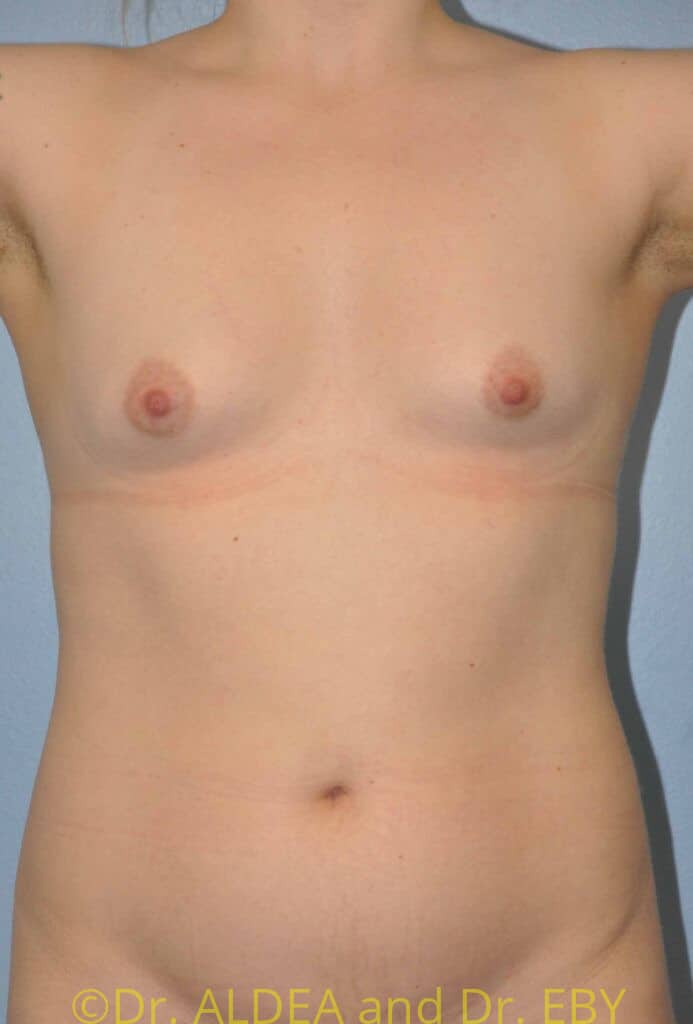 Before Image: Trans Breast Augmentation #258 - front