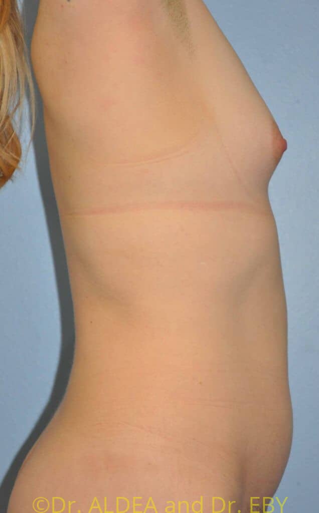 Before Image: Trans Breast Augmentation #258 - right-side