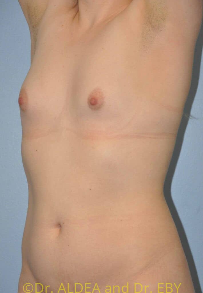 Before Image: Trans Breast Augmentation #258 - left-front-oblique