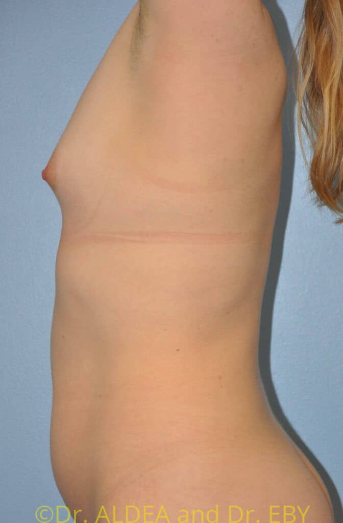 Before Image: Trans Breast Augmentation #258 - left-side