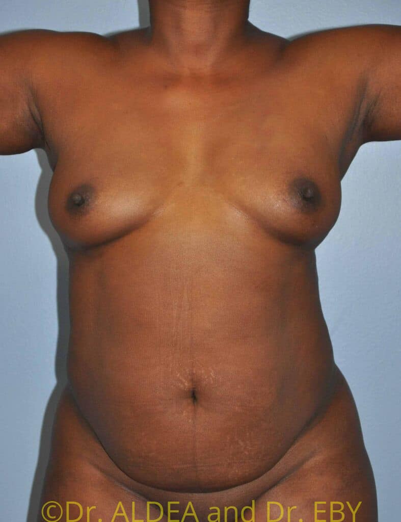Before Image: Tummy Tuck #954 - front