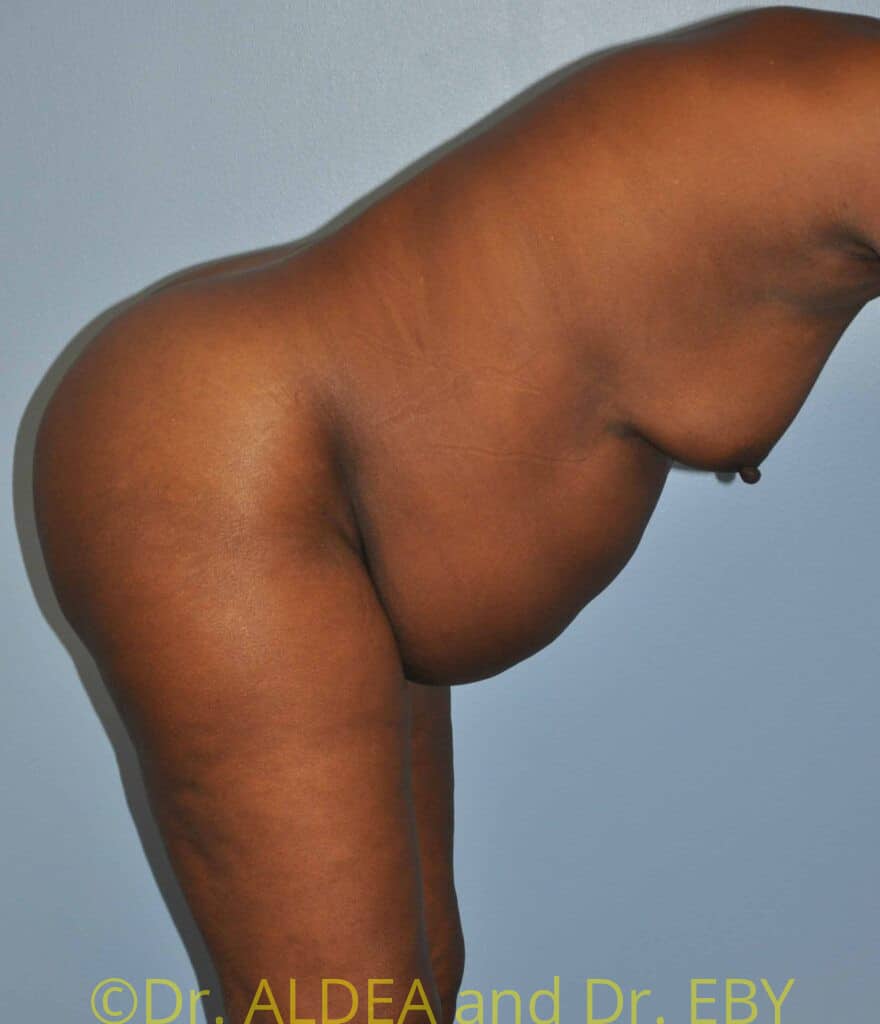 Before Image: Tummy Tuck #954 - other