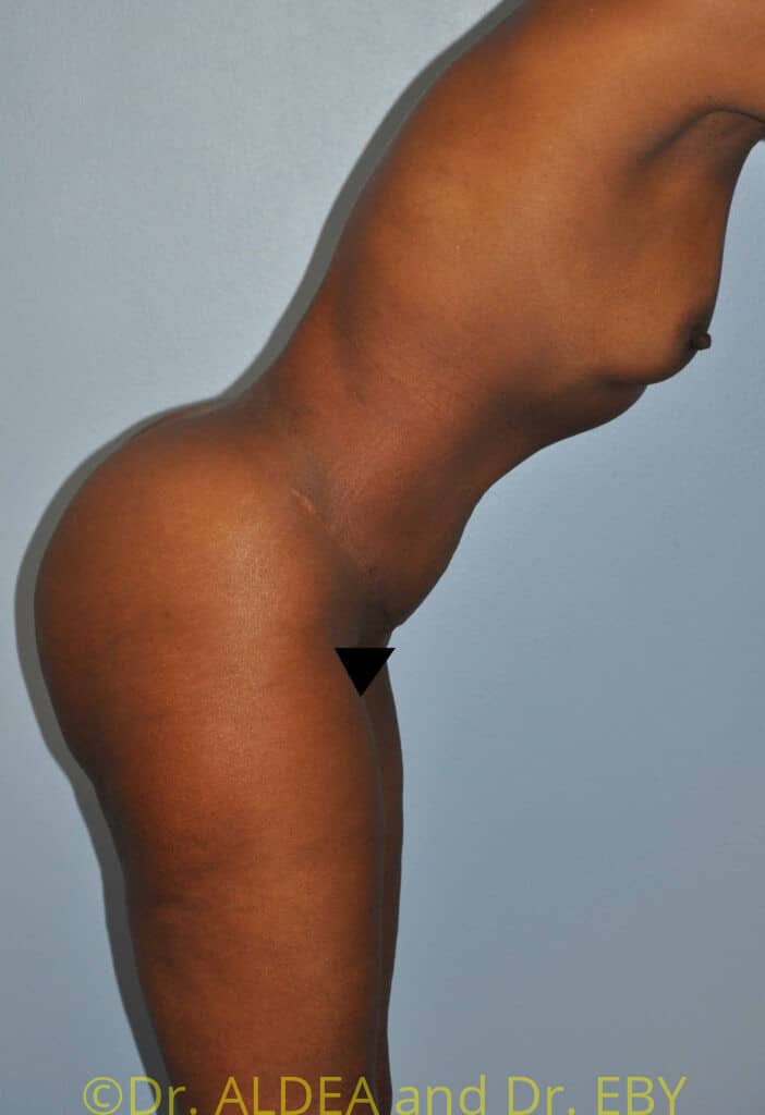 After Image: Tummy Tuck #954 - other