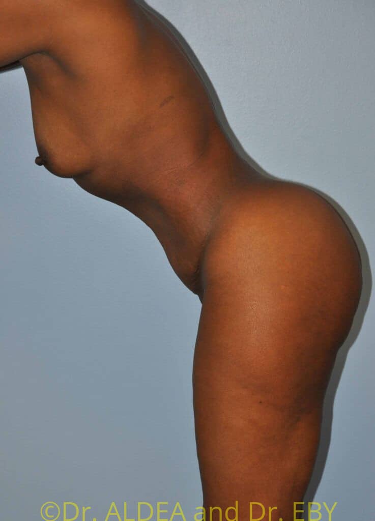 After Image: Tummy Tuck #954 - other