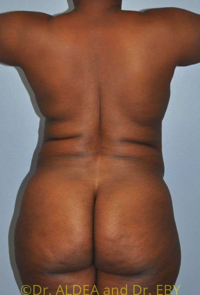 Before Image: Tummy Tuck #954 - back