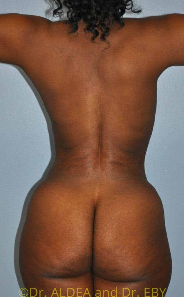 After Image: Tummy Tuck #954 - back