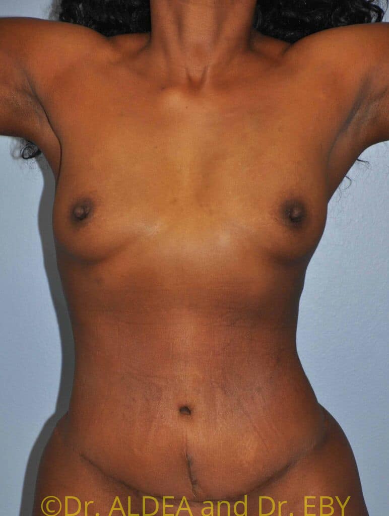 After Image: Tummy Tuck #954 - front