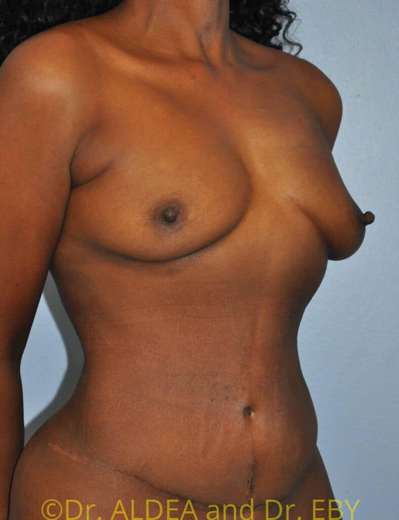 Before Image: Tummy Tuck #954 - right-front-oblique