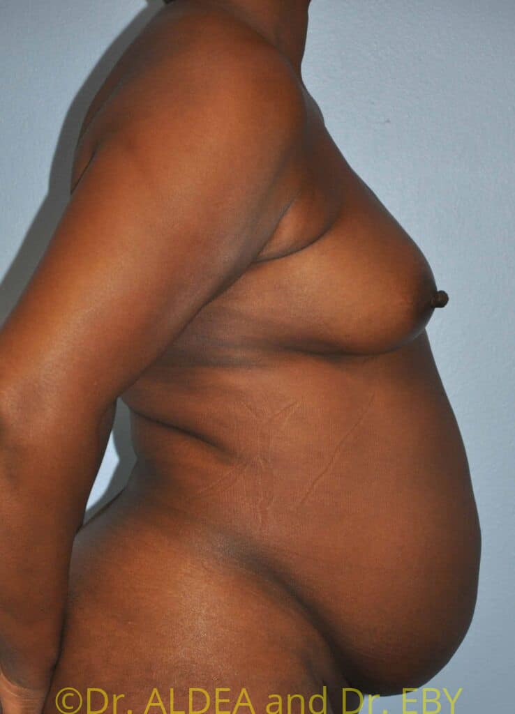 Before Image: Tummy Tuck #954 - right-side