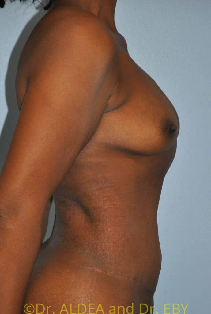 After Image: Tummy Tuck #954 - right-side