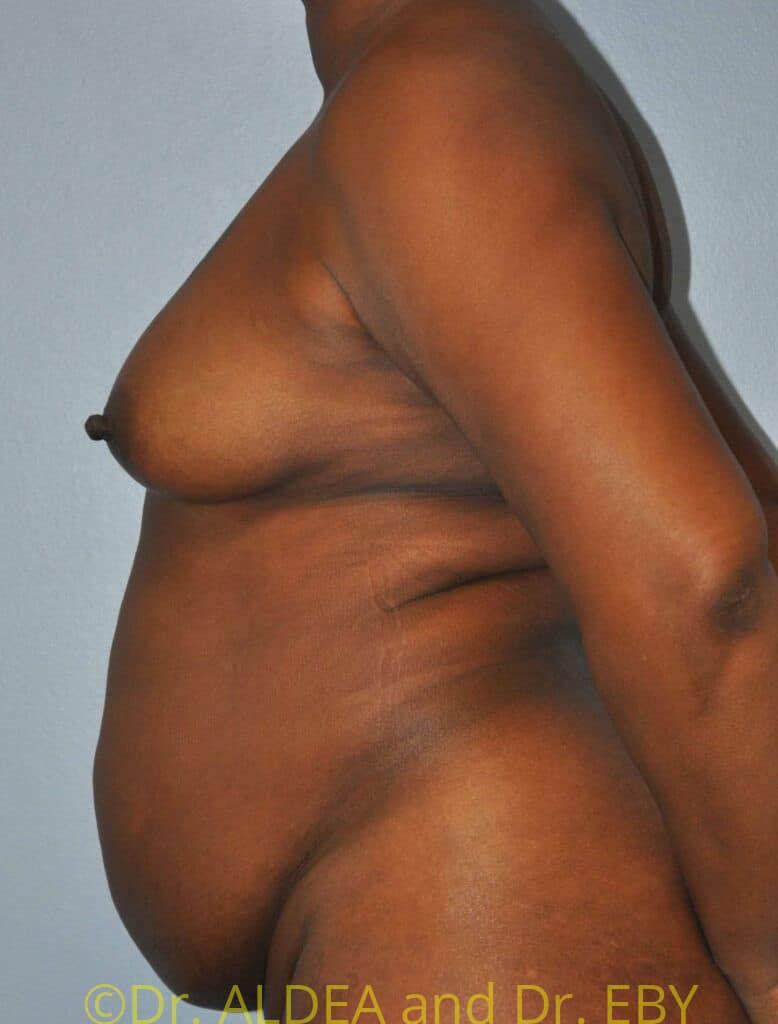 Before Image: Tummy Tuck #954 - left-side