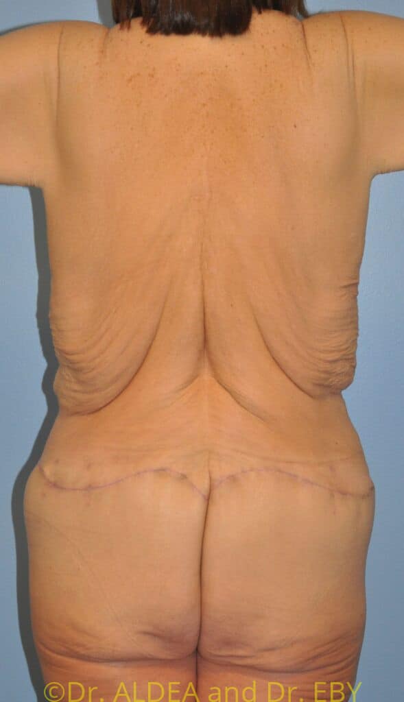Before Image: Weight loss Upper Back (Bra Line) Lift (UBL) #297 - back