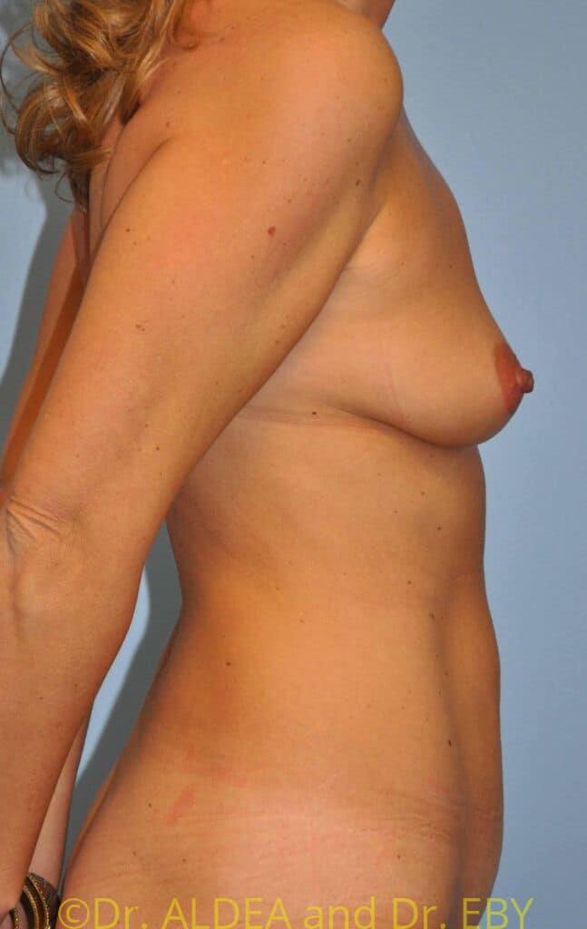 Before Image: Breast Augmentation w/ Lift #073 - right-side