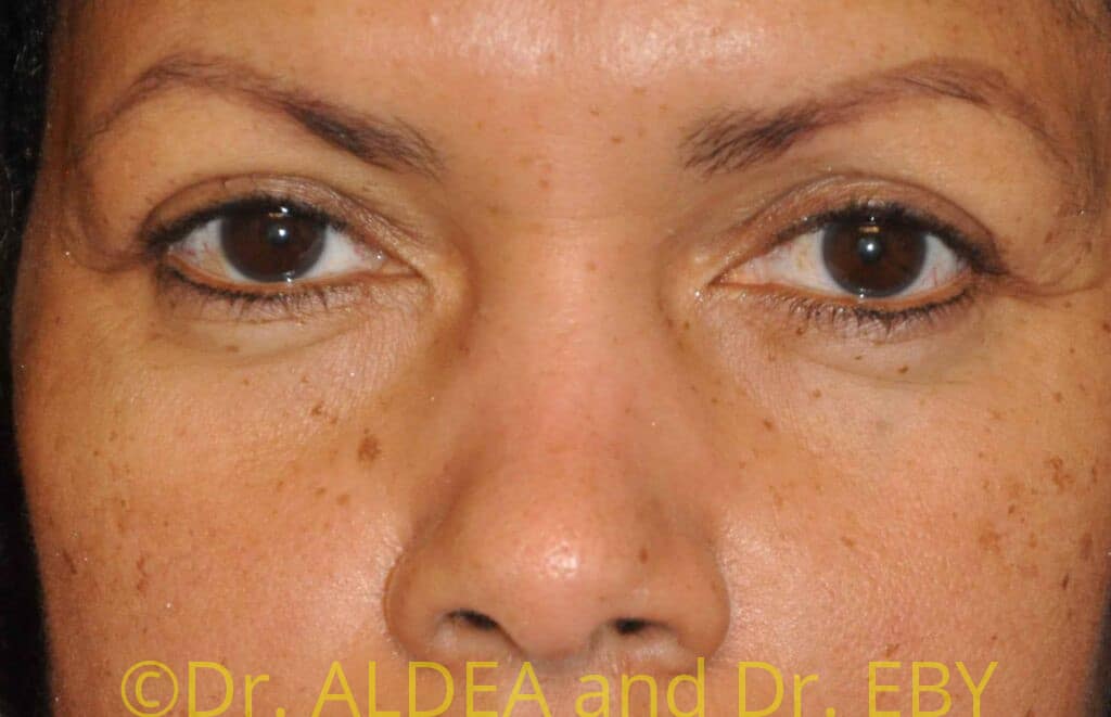 After Image: Blepharoplasty #387 - front