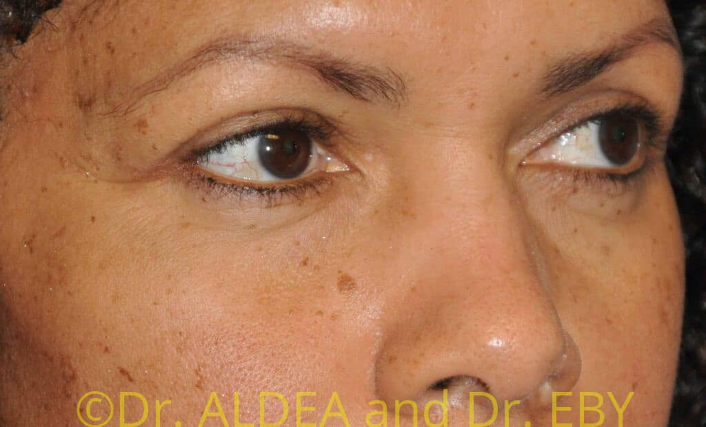 After Image: Blepharoplasty #387 - right-front-oblique