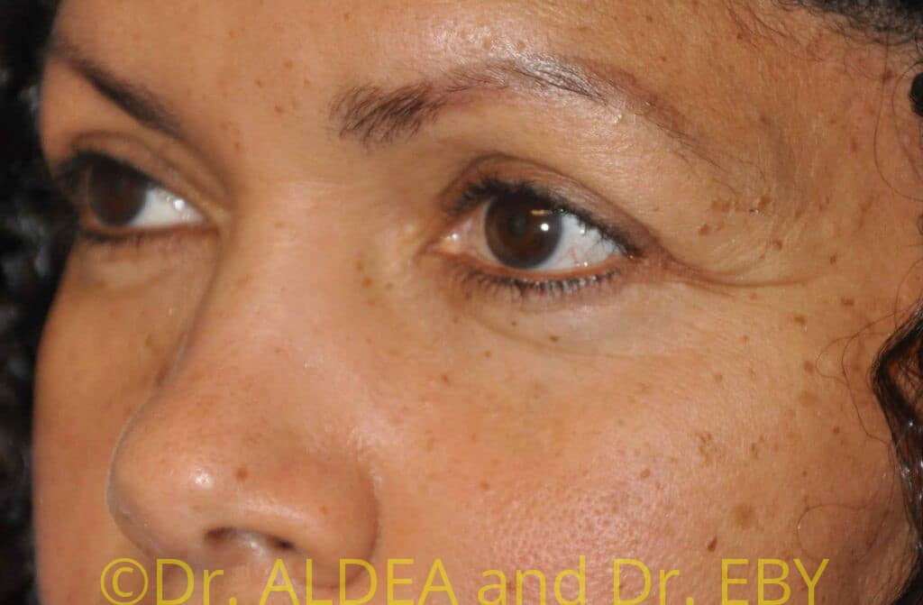 After Image: Blepharoplasty #387 - left-front-oblique