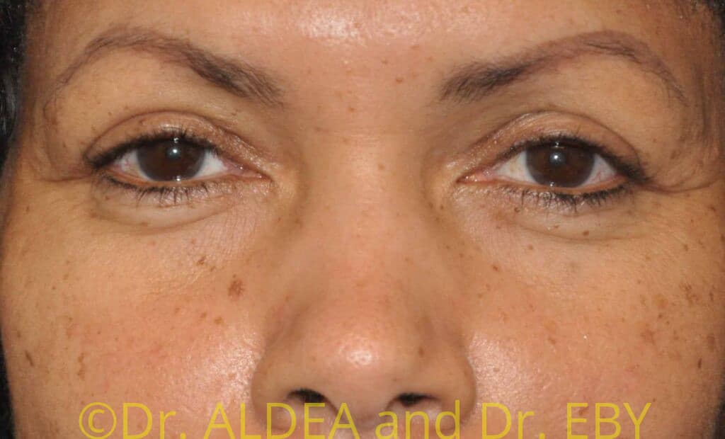 Before Image: Blepharoplasty #387 - front