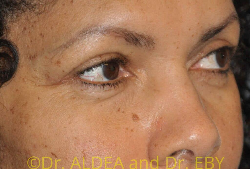 Before Image: Blepharoplasty #387 - right-front-oblique