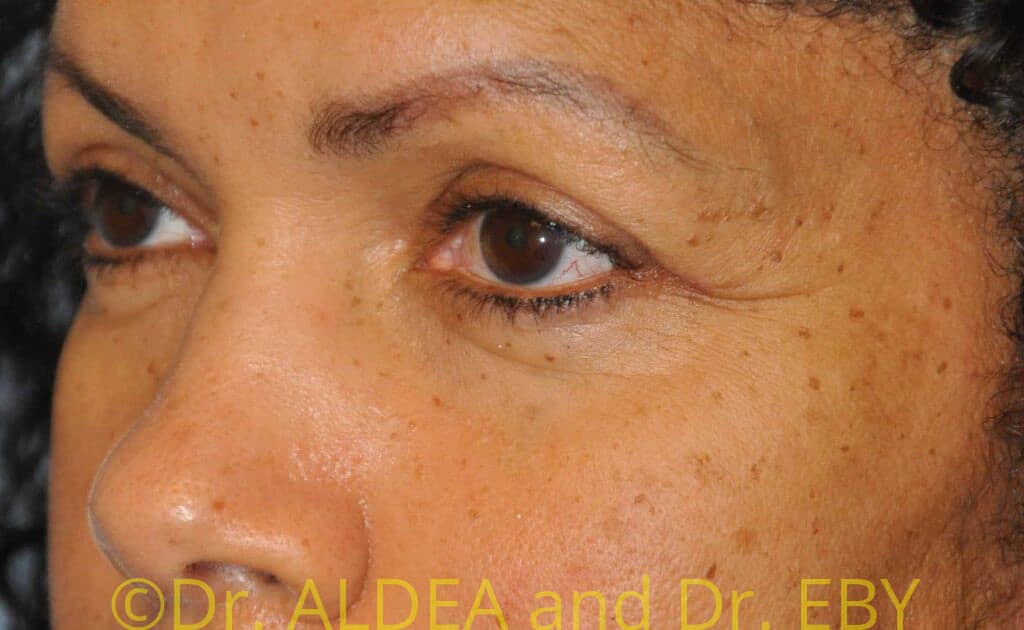 Before Image: Blepharoplasty #387 - left-front-oblique
