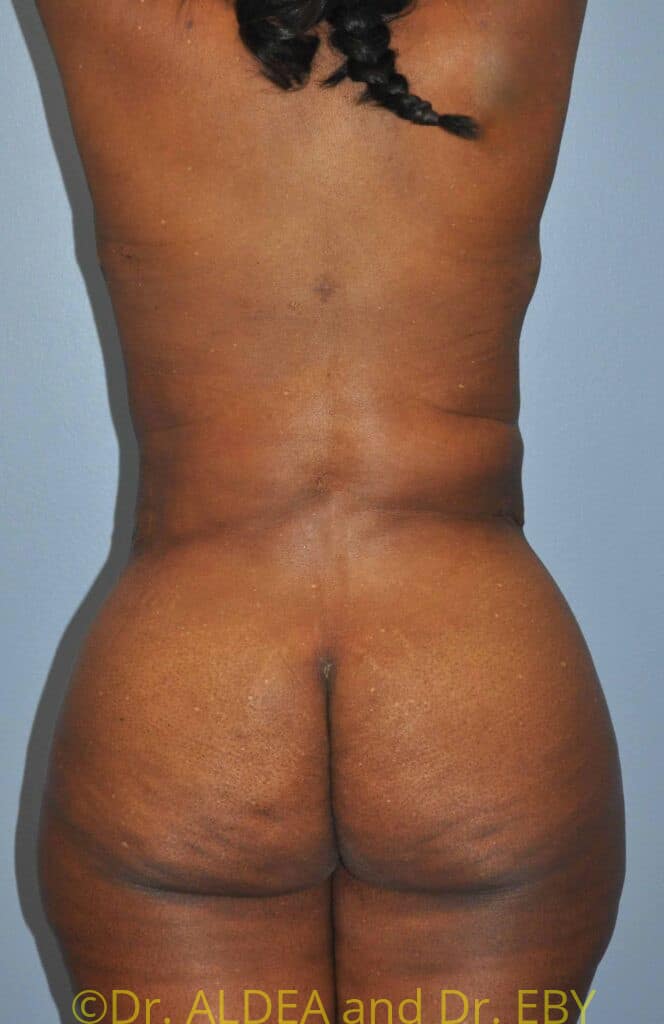 After Image: Back Scoop Liposuction #772 - back