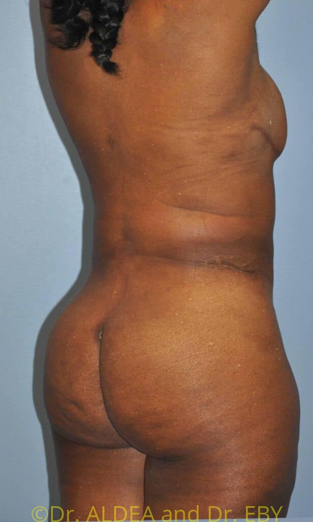 After Image: Back Scoop Liposuction #772 - right-back-oblique