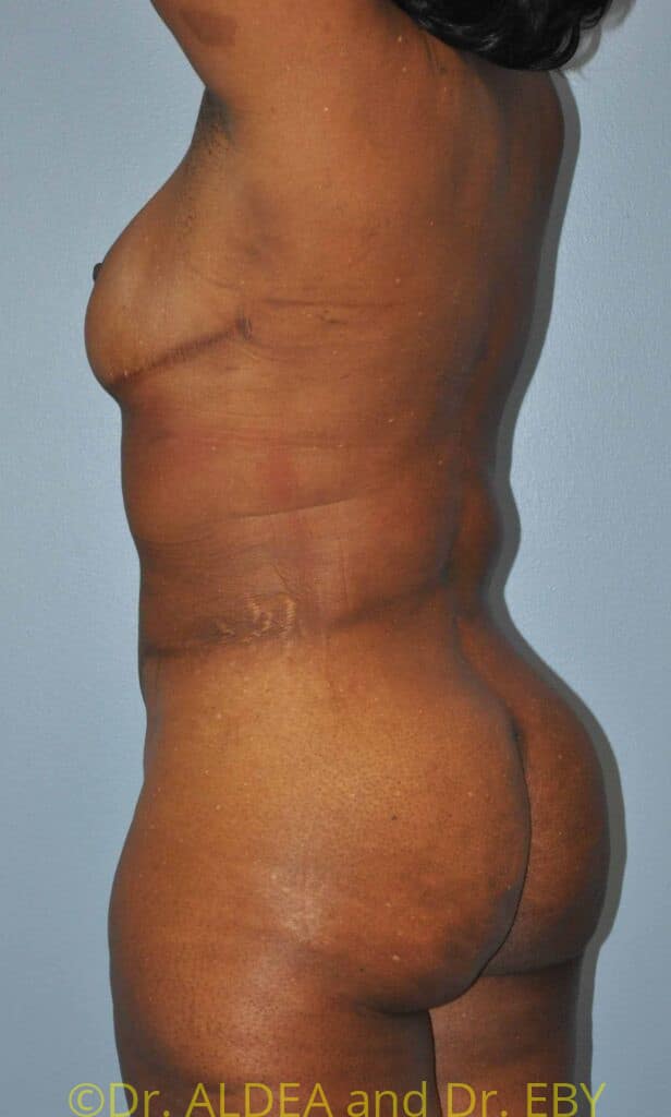 After Image: Back Scoop Liposuction #772 - left-back-oblique
