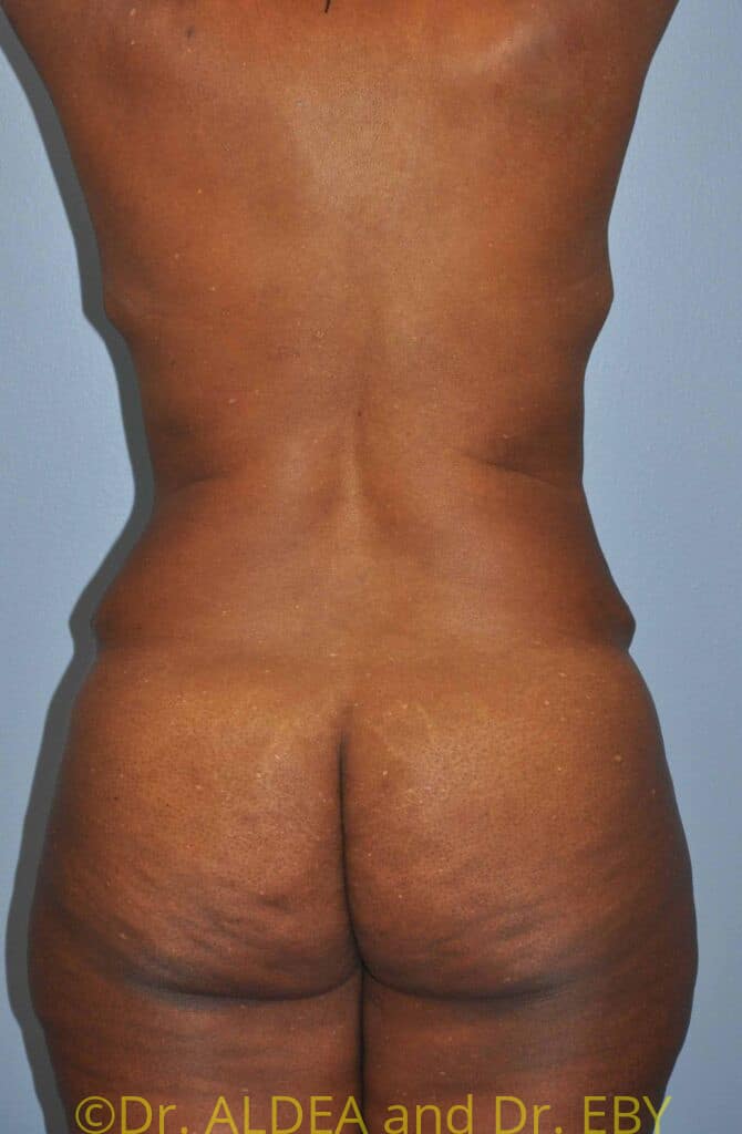 Before Image: Back Scoop Liposuction #772 - back