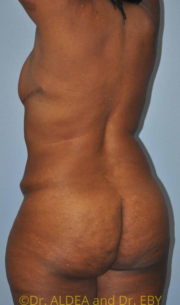 Before Image: Back Scoop Liposuction #772 - left-back-oblique
