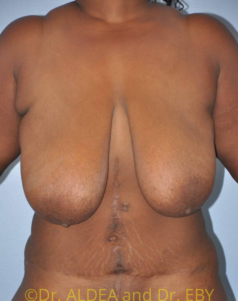 Before Image: Short Scar Breast Reduction #997 - front