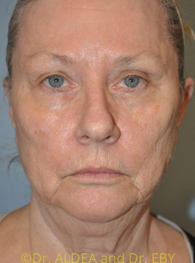 Before Image: Facelift #573 - front