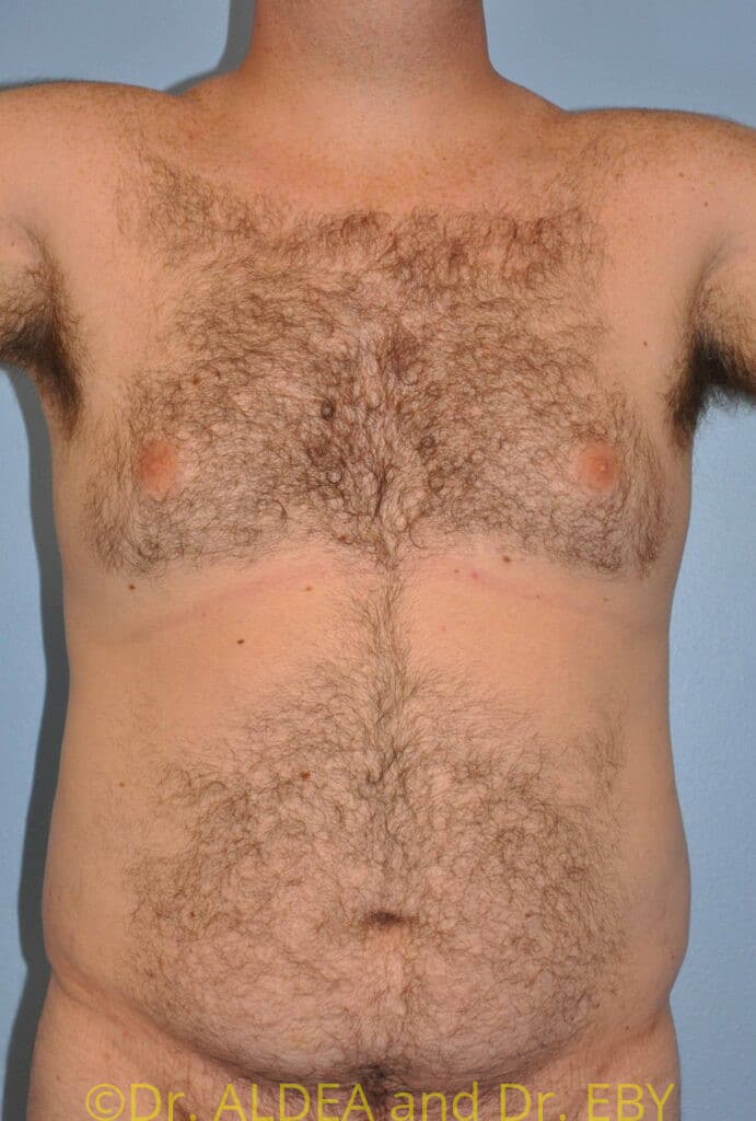 Before Image: Gynecomastia #905 - front