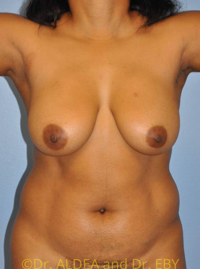 Before Image: Liposuction #602 - front