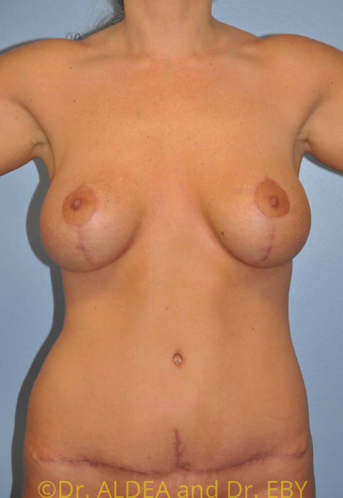 After Image: Mommy Makeover #232 - front