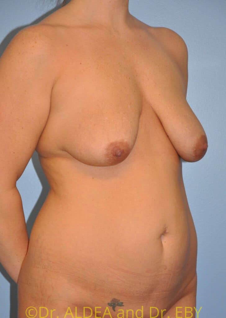 Before Image: Mommy Makeover #232 - right-front-oblique