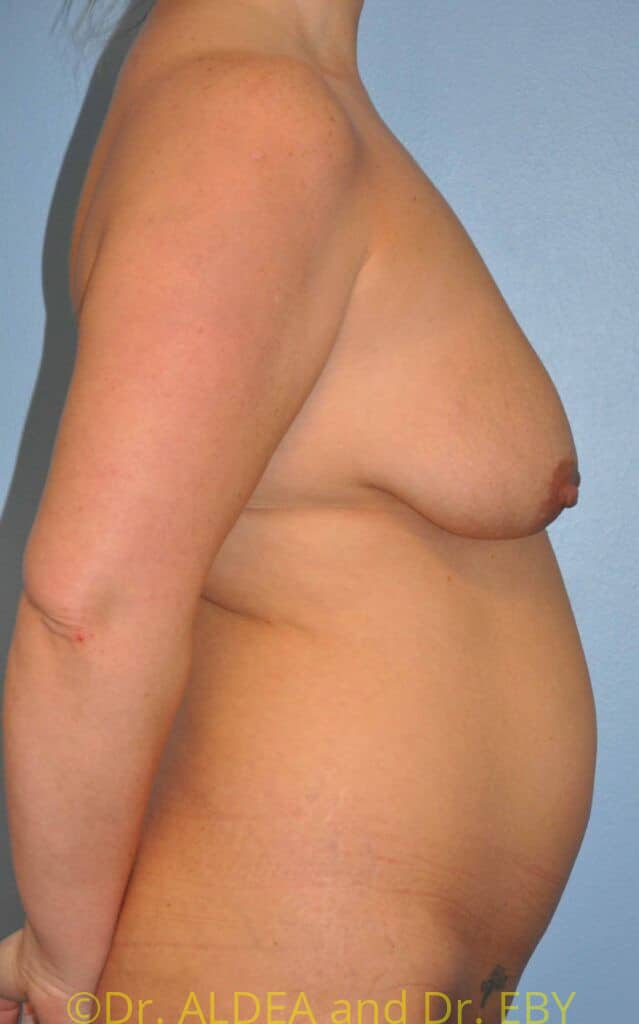 Before Image: Mommy Makeover #232 - right-side