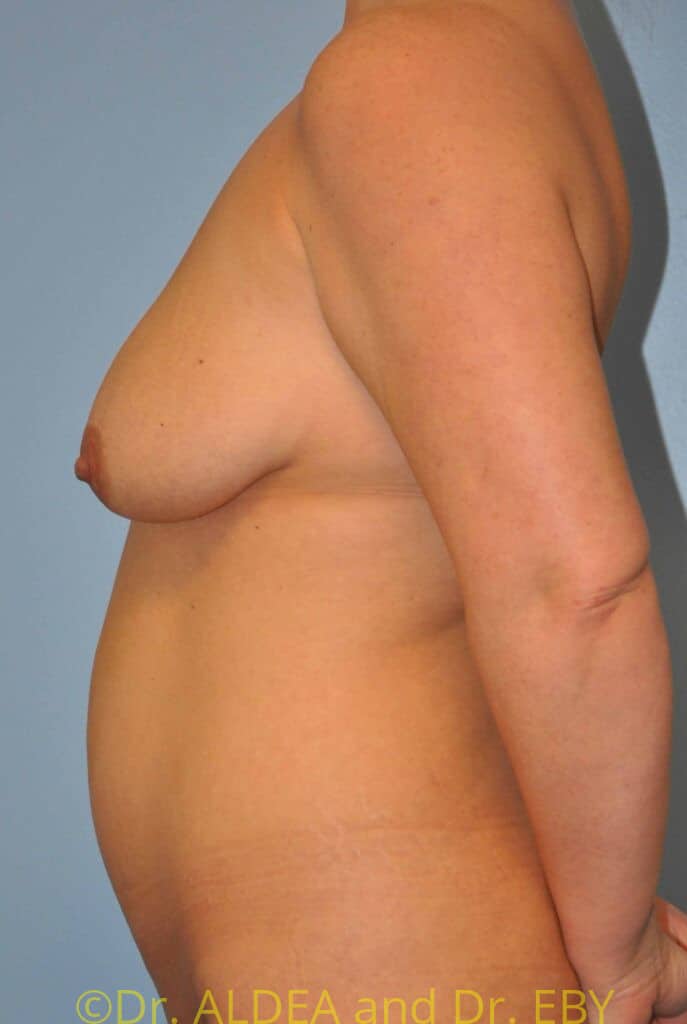 Before Image: Mommy Makeover #232 - left-side