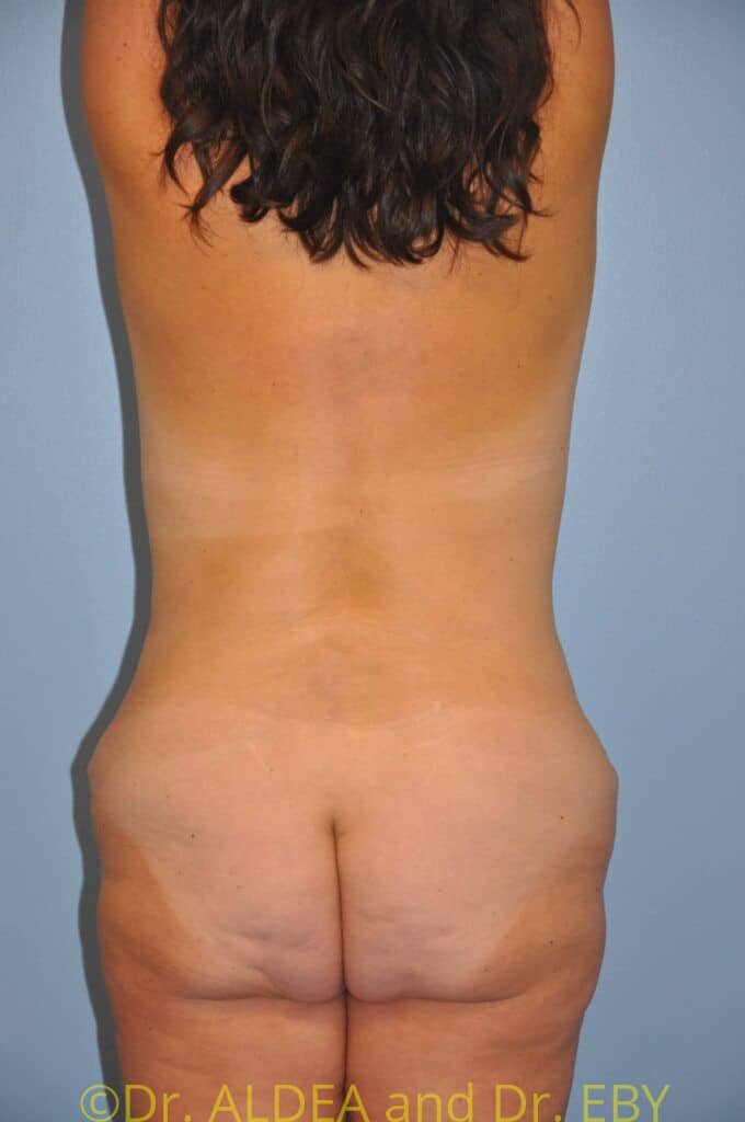 Before Image: Weight loss (MWL) Butt and Thigh Lift #902 - back