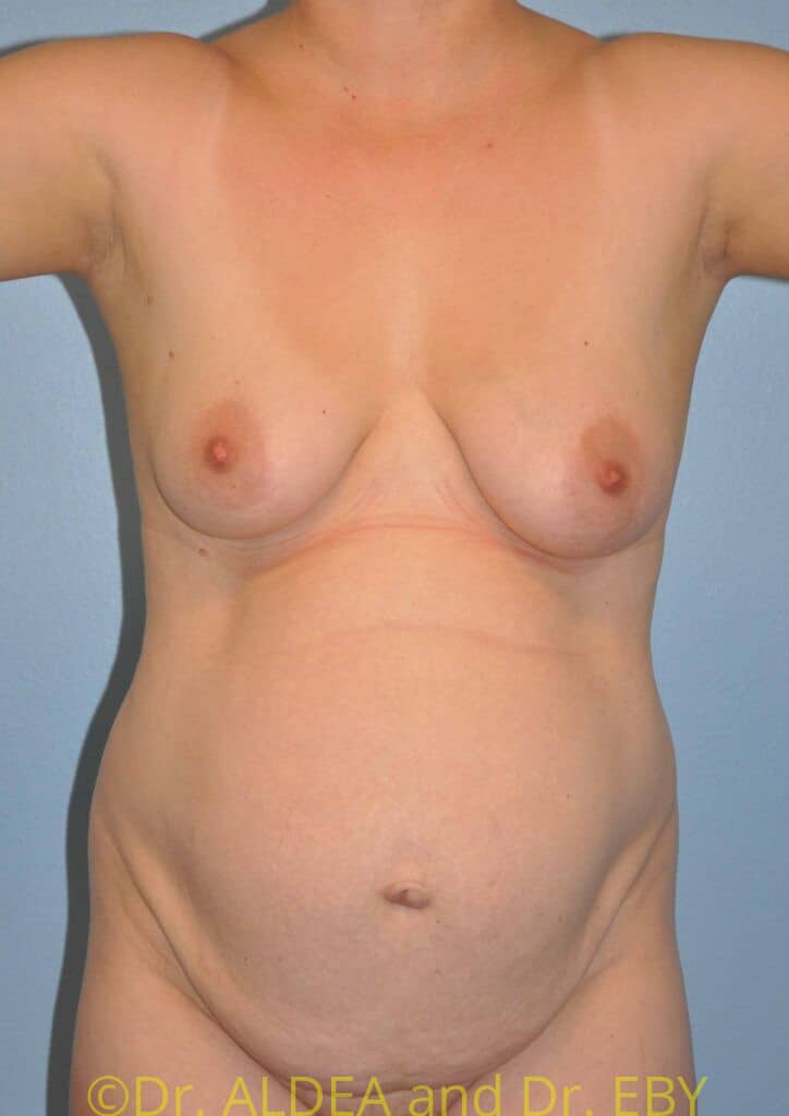 Before Image: Tummy Tuck #982 - front