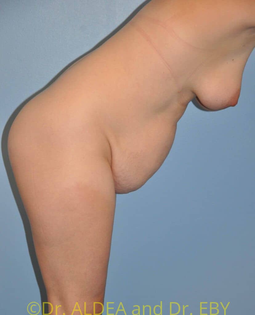 Before Image: Tummy Tuck #982 - other
