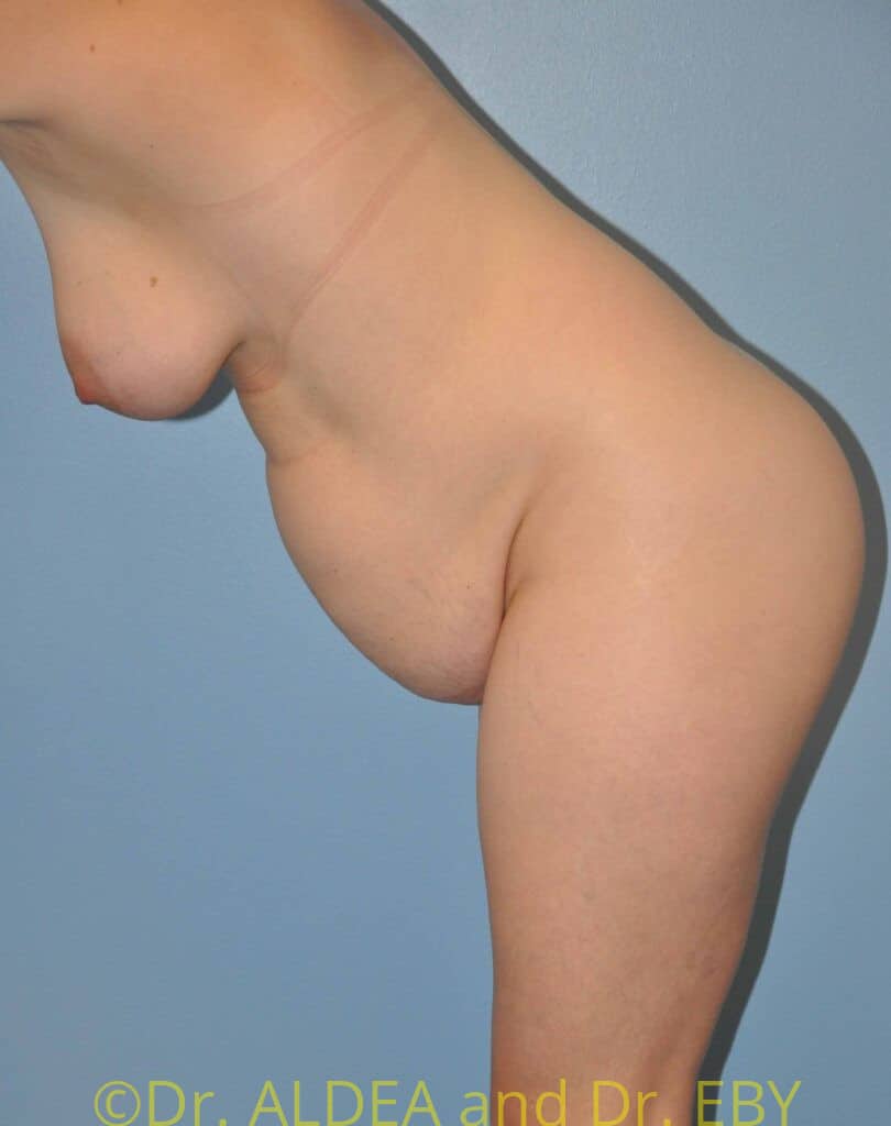 Before Image: Tummy Tuck #982 - other