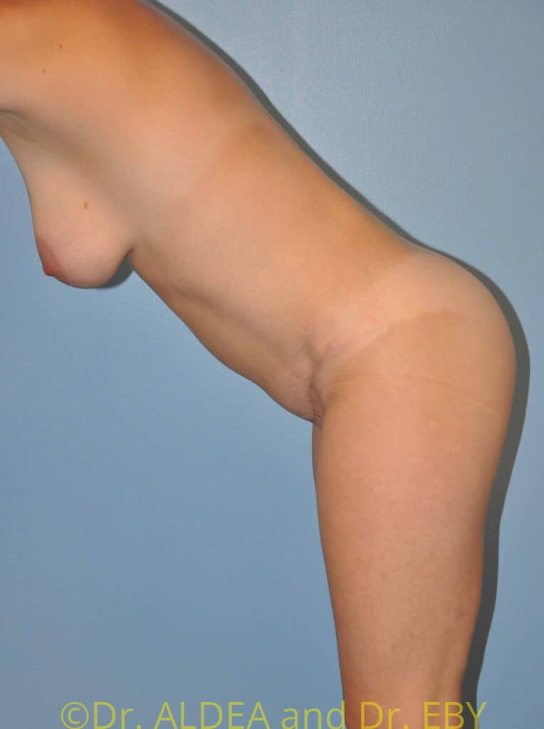 After Image: Tummy Tuck #982 - other