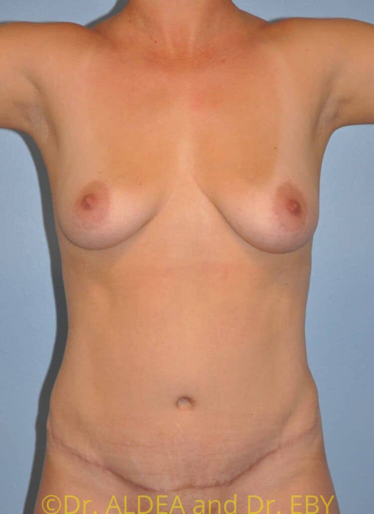 After Image: Tummy Tuck #982 - front