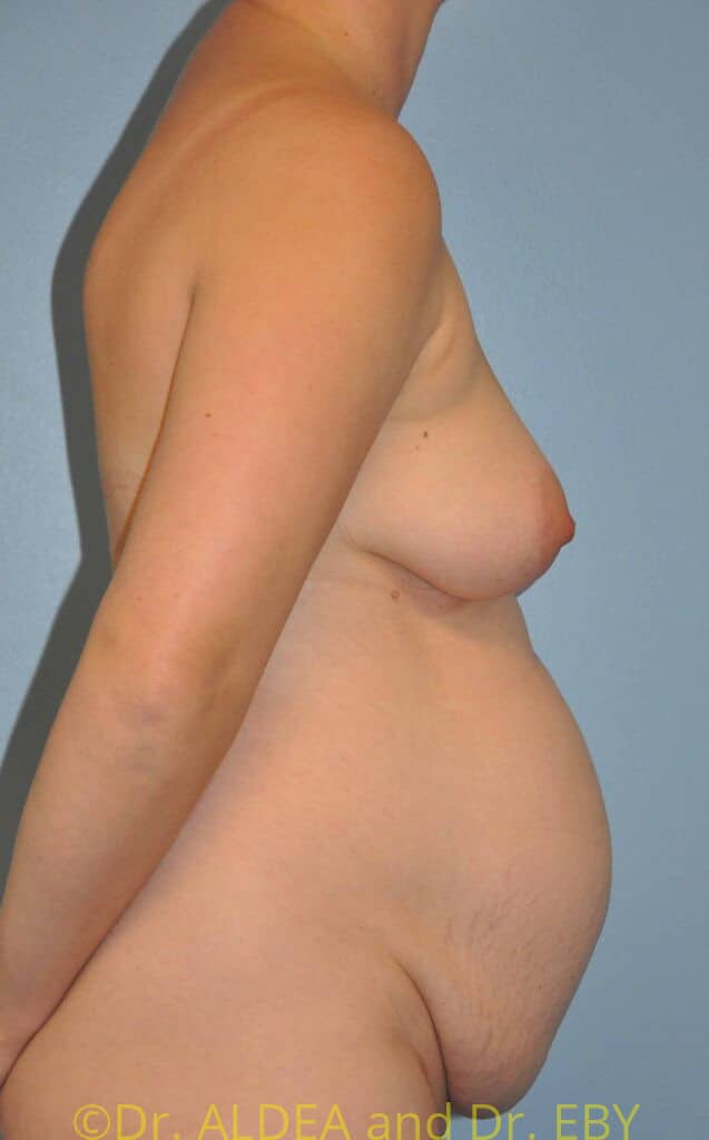 Before Image: Tummy Tuck #982 - right-side