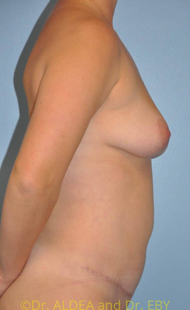 After Image: Tummy Tuck #982 - right-side